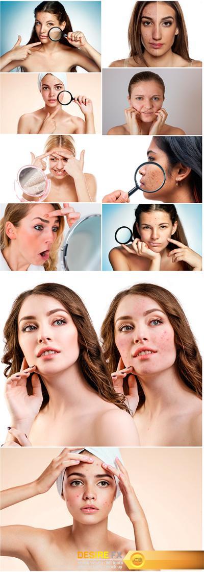 Young woman with problematic skin – 10UHQ JPEG